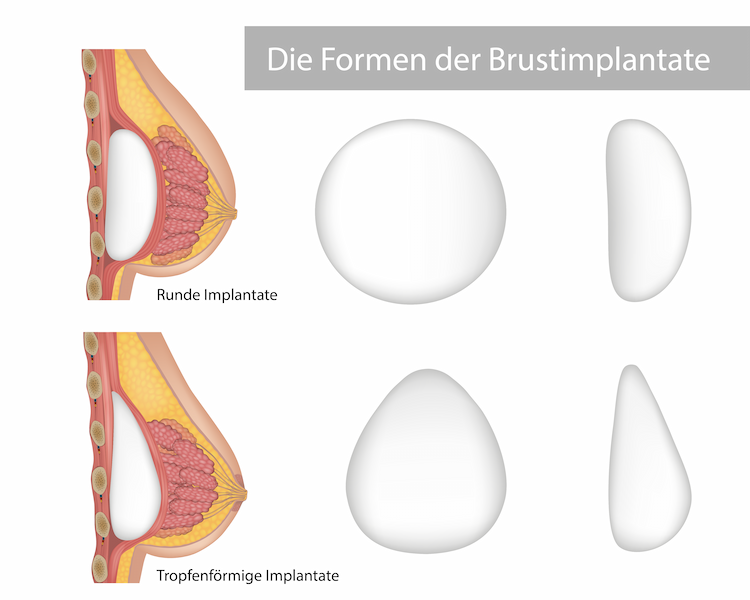 Die Formen der Brustimplantate: Runde oder tropfenförmige Implantate?