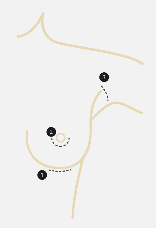 Dieses Foto zeigt verschiedene Schnittf&uuml;hrungen einer Brust-OP.